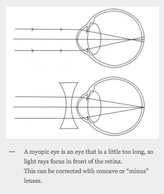 Myopia (Short Sightedness)